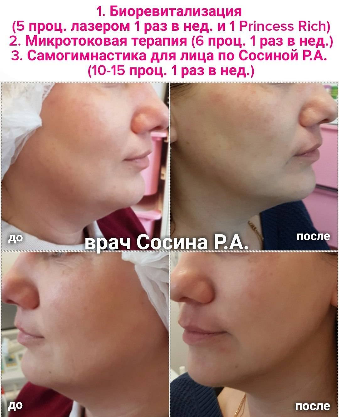 Препарат принцесс Рич биоревитализация